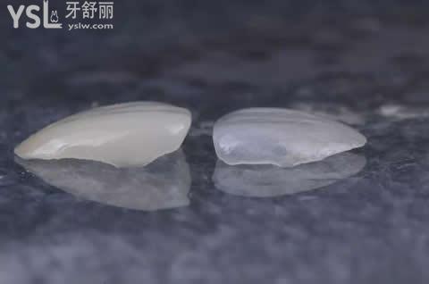 牙齒貼面的分類(lèi)？