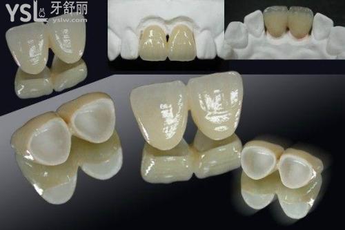 二氧化鋯全瓷冠特點(diǎn)：