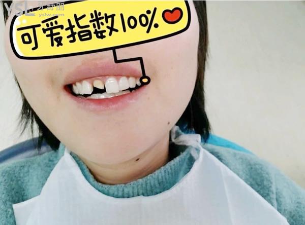 缺牙