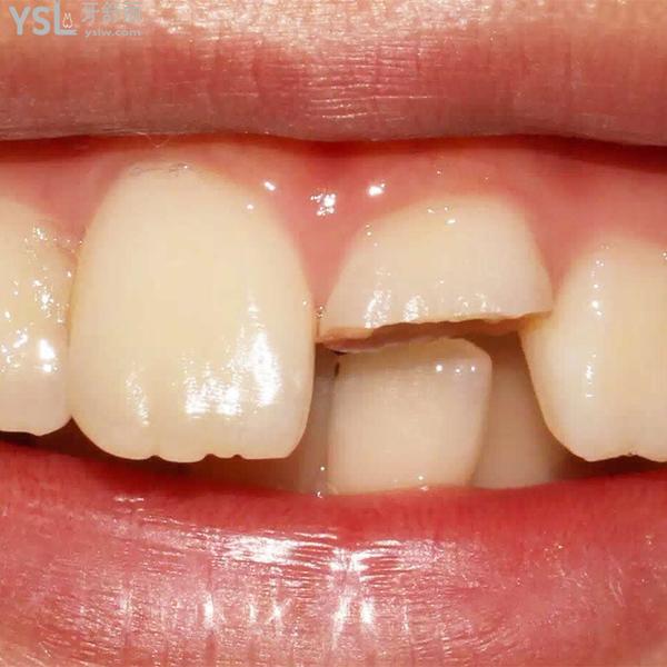門牙掉了一塊怎么辦怎么修復(fù)？學(xué)會這些方法就可以