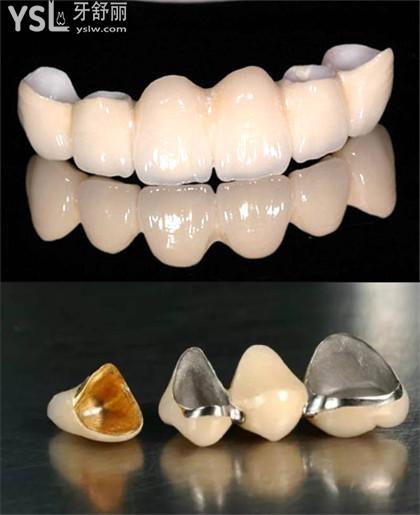 沈陽(yáng)烤瓷牙多少錢(qián)一顆