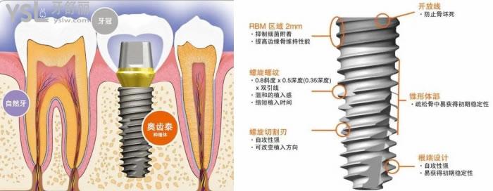 昆明種植牙價(jià)格
