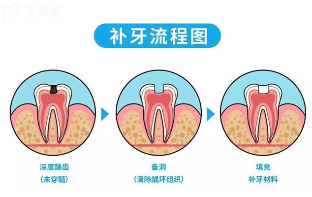 補(bǔ)牙過(guò)程