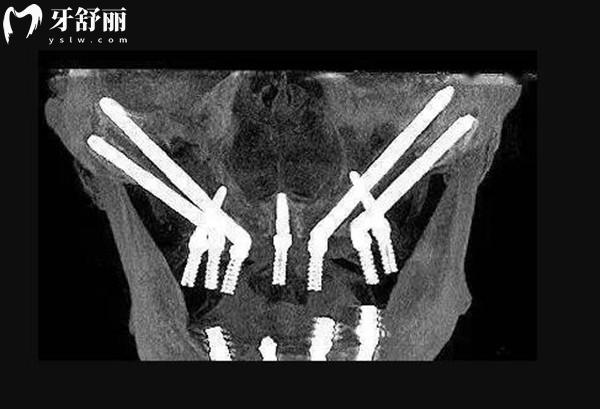 畢節(jié)金沙柯品牙管家口腔種植牙價格表