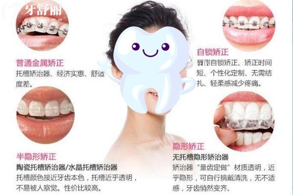 矯正牙套類(lèi)型