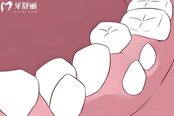 成人多生牙拔除有什么風(fēng)險嗎？