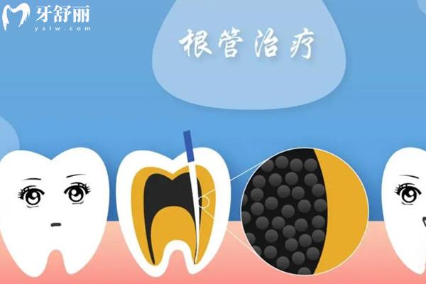 根管治療為啥前牙和后牙的價格不一樣？