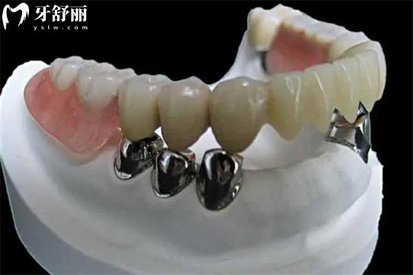 老年人牙齒掉光了裝什么假牙合適?價格一般多少錢？