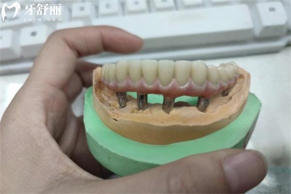 老年人牙齒掉光了裝什么假牙合適?價格一般多少錢？
