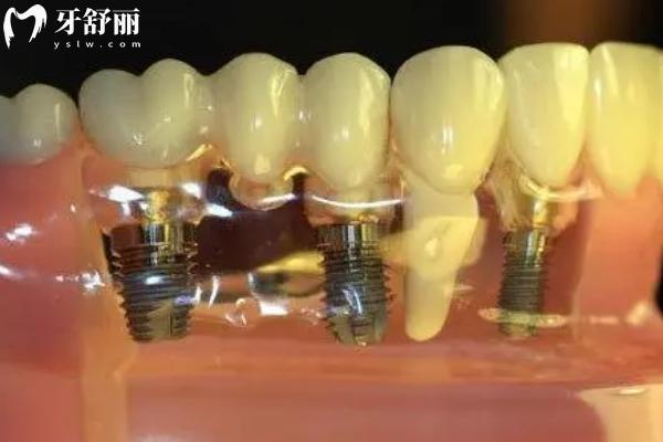 鈦鋯合金和純鈦哪個種植牙好？