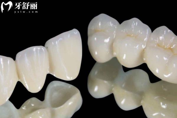 上海全瓷牙冠多少錢一顆