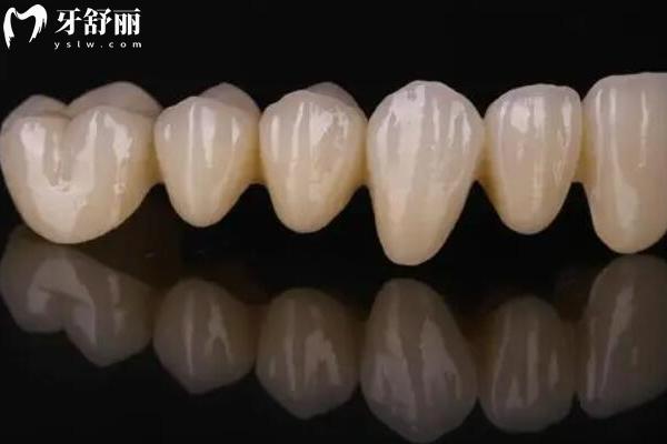 全瓷牙比烤瓷牙好在哪？為什么價格貴三倍？材料/工藝/美觀/適應(yīng)性等都與價格有關(guān)