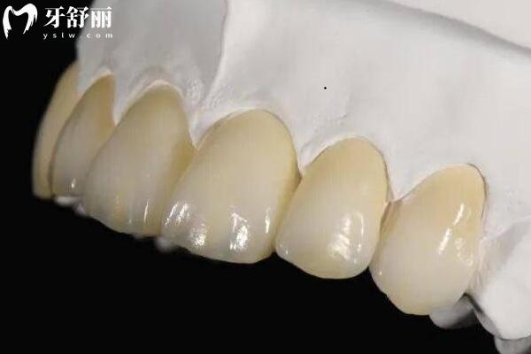 全瓷牙比烤瓷牙好在哪？為什么價格貴三倍？材料/工藝/美觀/適應(yīng)性等都與價格有關(guān)