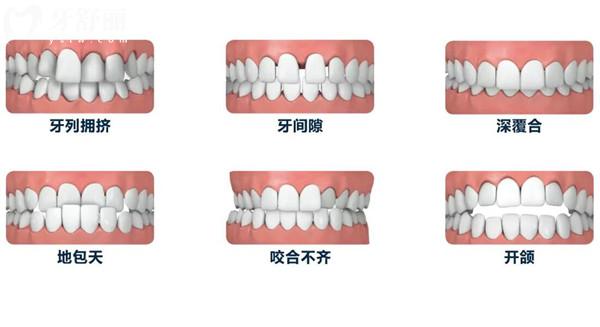 超全藍(lán)天口腔醫(yī)院2025年價(jià)格表清單:種植牙/正畸/鑲牙/美白/補(bǔ)牙/拔牙費(fèi)用一覽