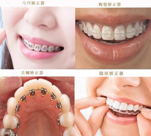 2025年鄭州牙科醫(yī)院收費價目表消費攻略:正畸/種植牙/鑲牙/美白等價格清單一覽