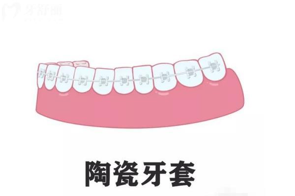 2025上海牙套價(jià)目表更新