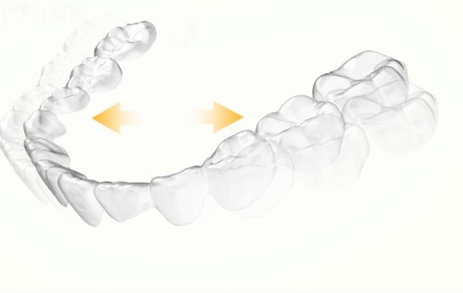 北京牙齒正畸費(fèi)用一般多少?金屬托槽7000+隱形矯正15000+兒童矯正3000+