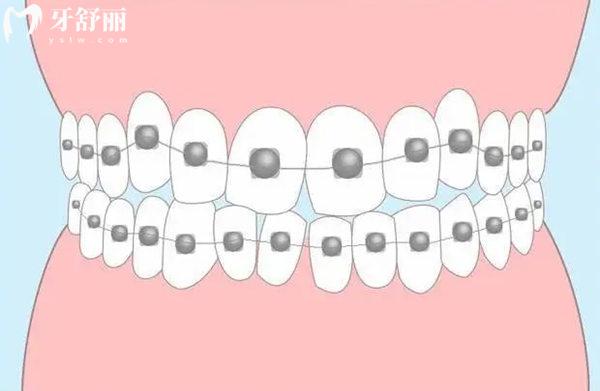 北京牙齒正畸費(fèi)用一般多少?金屬托槽7000+隱形矯正15000+兒童矯正3000+