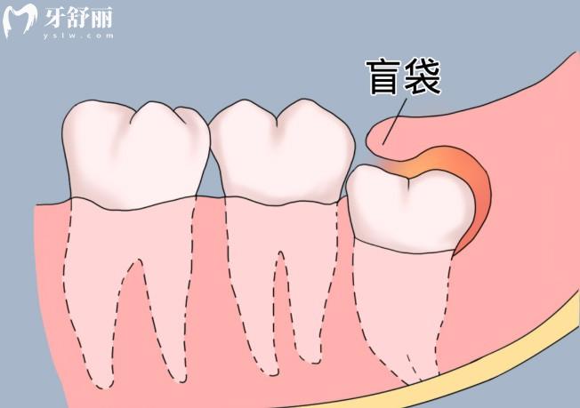 智齒長盲袋是什么樣的?智齒有盲袋位置正要拔嗎?下文帶你來揭秘