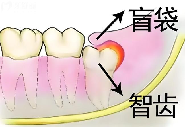 智齒長盲袋是什么樣的?智齒有盲袋位置正要拔嗎?下文帶你來揭秘