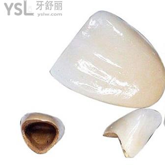 北京維樂口腔鈷鉻合金烤瓷牙價格貴嗎？