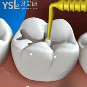北京維樂(lè)口腔成人3m樹(shù)脂補(bǔ)牙價(jià)格