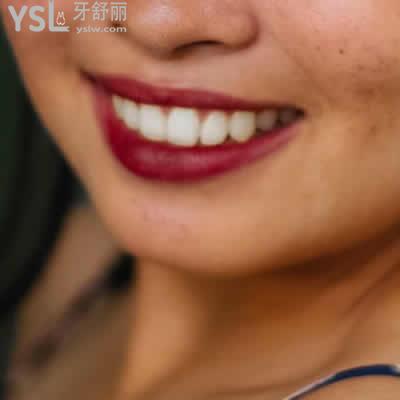 昆明長鵬口腔威蘭德全瓷牙價格表及優(yōu)點(diǎn)