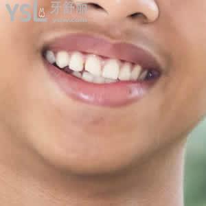 昆明長鵬口腔德國VOCO納米樹脂補(bǔ)牙價格表
