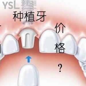 天津美奧口腔貴嗎？可以參考下進(jìn)口種植牙收費(fèi)如何。