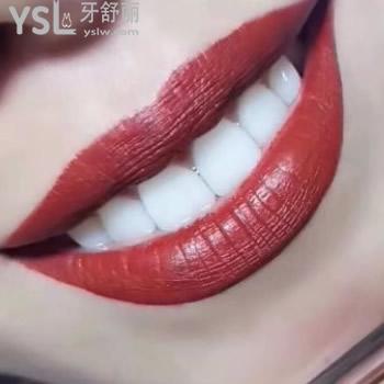 西安諾貝爾牙科義獲嘉e-max瓷貼面單顆多少錢？