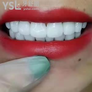 重慶成佳牙博士口腔醫(yī)院價格之全瓷貼面多少錢？