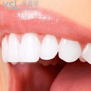 昆明美奧口腔價格表之傳統(tǒng)金屬矯正收費(fèi)標(biāo)準(zhǔn) ！