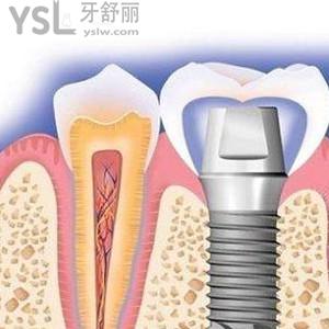 西寧時(shí)光口腔價(jià)格貴嗎？時(shí)光口腔周年慶之種植牙驚喜價(jià)