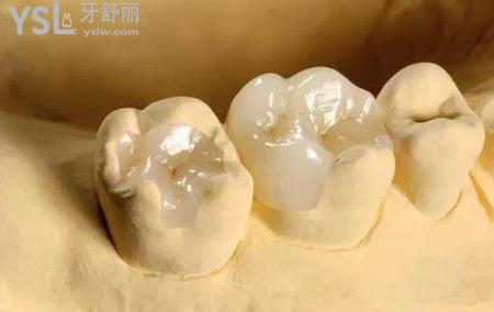 嵌體修復的優(yōu)勢是什么？