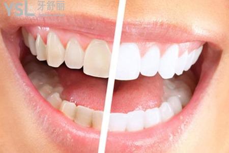 牙齒發(fā)黃怎么辦？