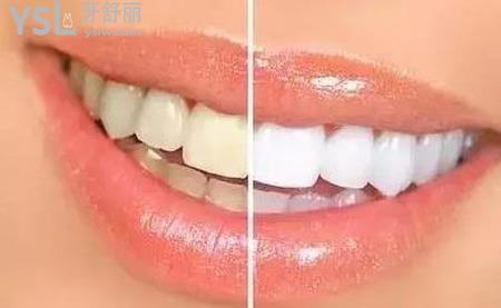 為什么每天刷牙牙齒還是很黃？