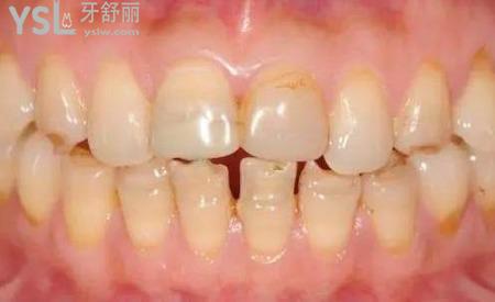 牙齒很黃怎么辦？