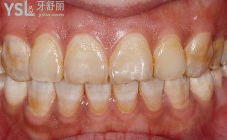 氟斑牙用小蘇打好嗎？