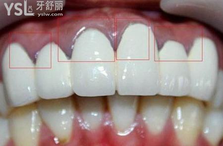 牙齒全掉完了能做烤瓷牙嗎？
