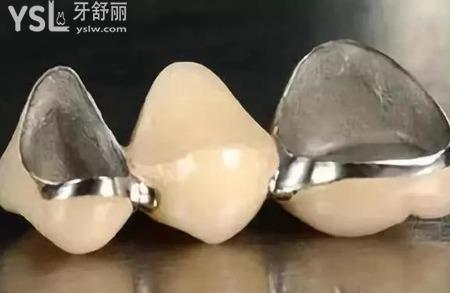 烤瓷牙是怎么安裝的？