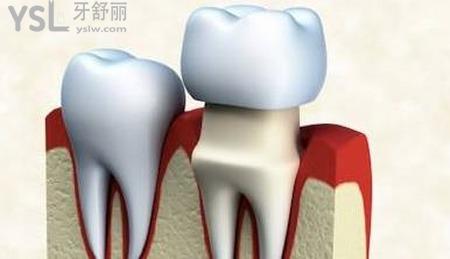做個牙冠需要多少錢？