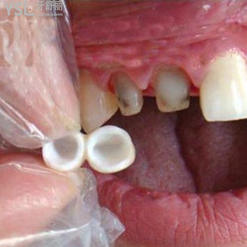 陶瓷牙套和鋼牙套哪個好？