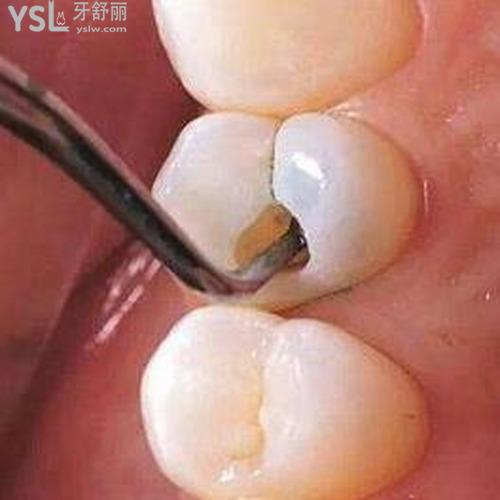 蛀牙就剩牙根了好拔嗎？