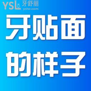 牙貼面是什么樣子？