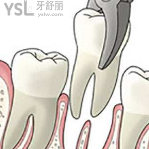 兒童乳牙松動(dòng)后能不能拔掉？