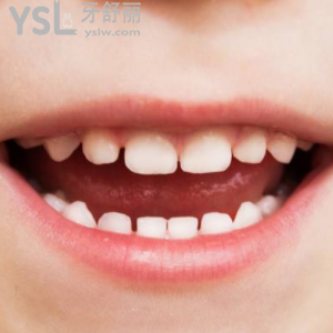 小孩補(bǔ)顆蟲(chóng)牙一般多少錢(qián)一顆？