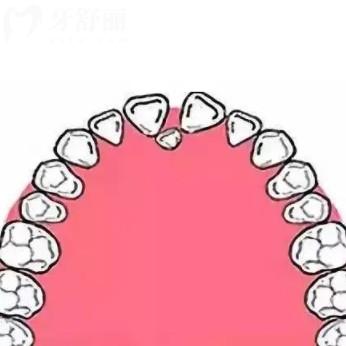 成人多生牙拔除有什么風(fēng)險嗎？