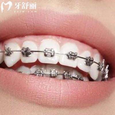 告知曲靖正規(guī)口腔醫(yī)院收費(fèi)標(biāo)準(zhǔn)是怎樣的，價(jià)目表更新包含舌側(cè)隱形矯正等項(xiàng)目