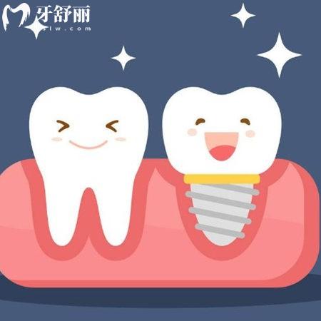 公開廊坊牙科種植牙價(jià)格表:中諾3000+|圣潔2380+技術(shù)好收費(fèi)還不貴