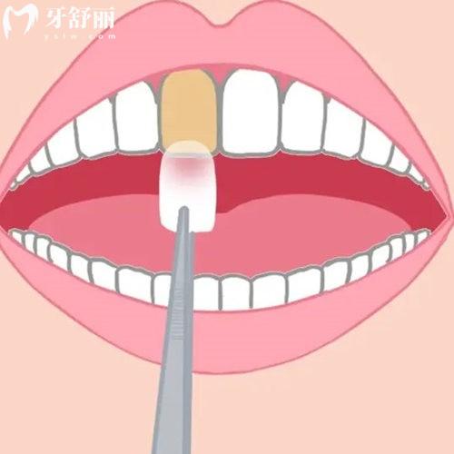 2025北京牙齒貼面的價格是多少?快看北京牙齒貼面不同品牌收費標準不貴